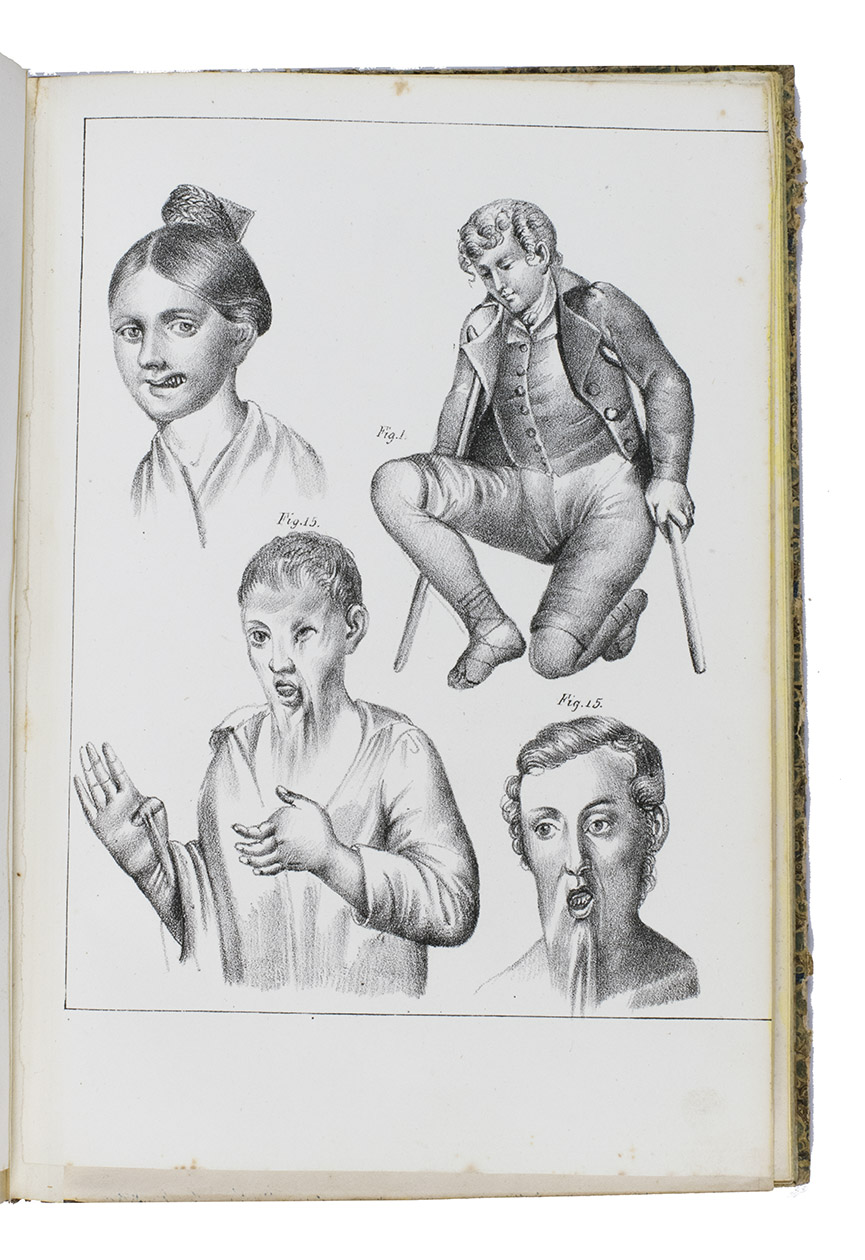 BRUNI, Lorenzo. - Sopra la sezione del tendine d'Achille e di qualche altro tendine come mezzo curativo dei piedi torti. Seconda edizione.Naples, Filiatre Sebezio, 1845. With:(2) IDEM. Agl'illustri scienziati del settimo congresso Italiano... Naples, [Filiatre Sebezio?], 1845. With 2 double-page and 14 full-page lithographs.(3) IDEM. Su i vantaggi che la ginnastica apporta al fisico al morale e a qualche malattia costituzionale. Naples, Filiatre Sebezio, 1844.(4) IDEM. Risultamenti clinici ottenuti nella sala ortopedica nell' ospedale di Santa Maria di Loreto in tutto l'anno del 1841. Naples, Ministero di Stato degli affari interni, [1841]. With 4 folding lithographed plates.(5) IDEM. Risultamenti clinici ottenuti nella sala ortopedica nell' ospedale di Santa Maria di Loreto in tutto l'anno del 1842. Naples, Filiatre Sebezio, [1842]. With 3 lithographed plates, including 1 folding.5 works in 1 vol. Super Royal (except ad 1 Demy) 8vo, mostly in 4s. Contemporary half tanned sheepskin, marbled sides, gold- and black-tooled spine with title in 2nd of 5 fields.